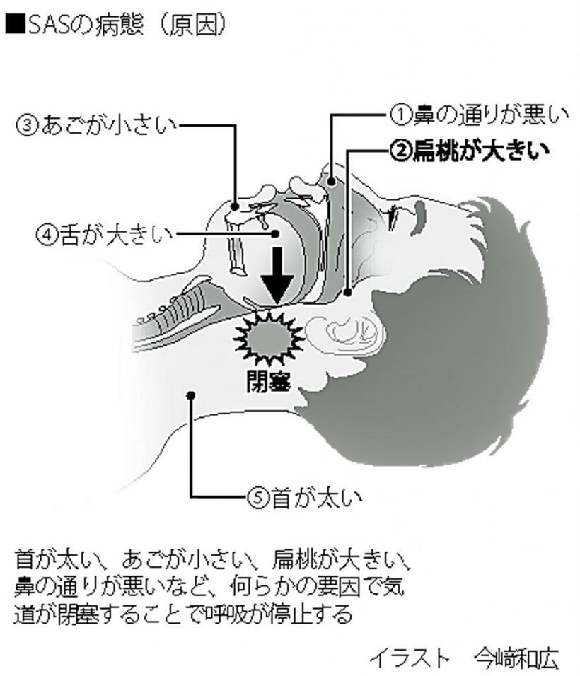 SASの病態（原因）