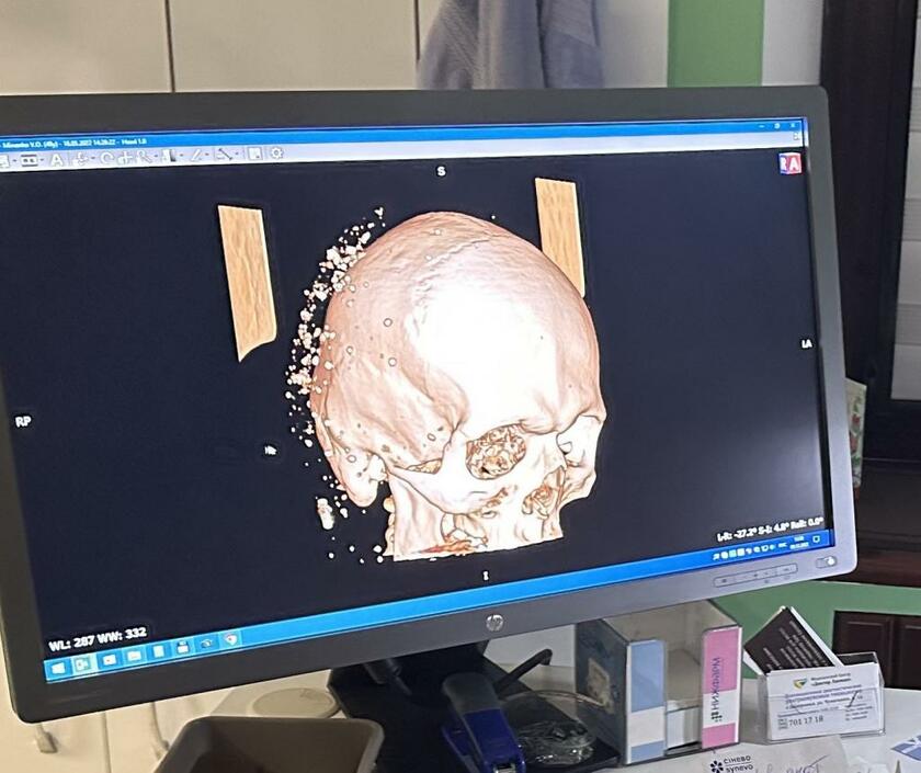 砲弾の破片を受けた患者の画像＝ザポリージャ市で、岡野直撮影
