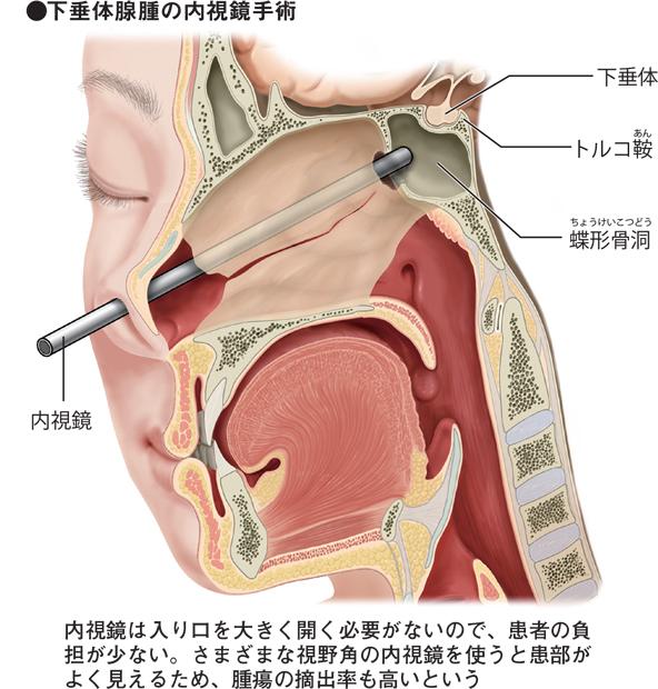 下垂体腺腫の内視鏡手術