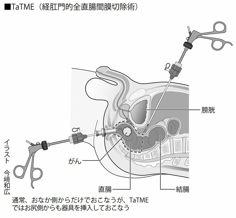 ■ＴａＴＭＥ（経肛門的全直腸間膜切除術）（週刊朝日　２０１８年５月１８日号より）