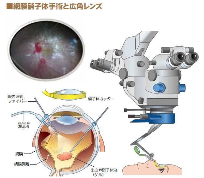 眼球に３カ所穴をあけて細い手術器具を挿入し、網膜の修復や、硝子体を切除して止血や増殖膜の除去などをおこなう。広角レンズを使用することで視野が広がり、画像のように眼底の端のほうまでよく見えるようになる（画像提供／寺崎医師、イラスト／寺平京子）