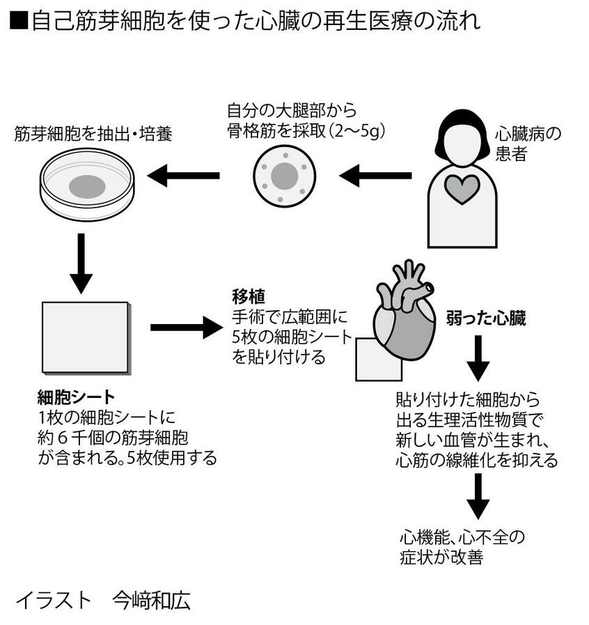 写真・図版(3枚目)| 患者数120万人の「心不全」、重症化を防ぐには? 進行を抑える最新治療も登場