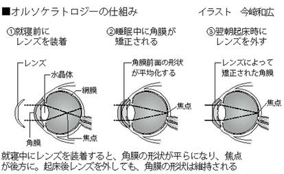 写真・図版(3枚目)| 子どもの近視がコロナで増加 対策は? 医師が警鐘「進行すると将来的に目の病気のリスク高く」