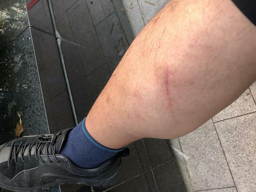 香港での切り傷。当たったのが錆びた鉄板だったので、感染症は気になったがなんともなかった。洗顔ペーパーのおかげだろうか？