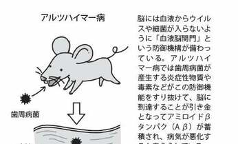 最新研究でわかった 歯周病菌がアルツハイマー病を悪化させる?