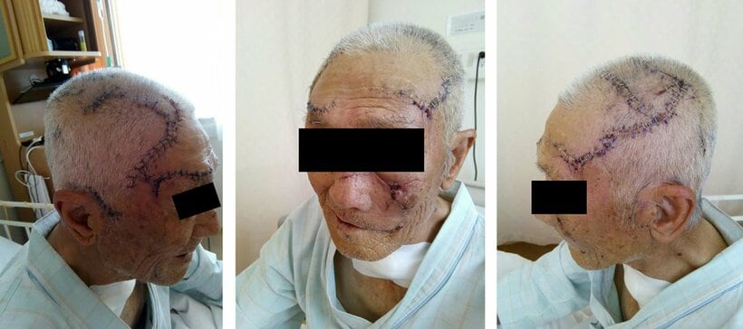 植林作業にクマに襲われた70代の男性。術後13日目＝秋田大学医学部付属病院提供
