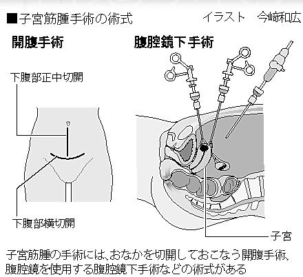 子宮筋腫手術の術式