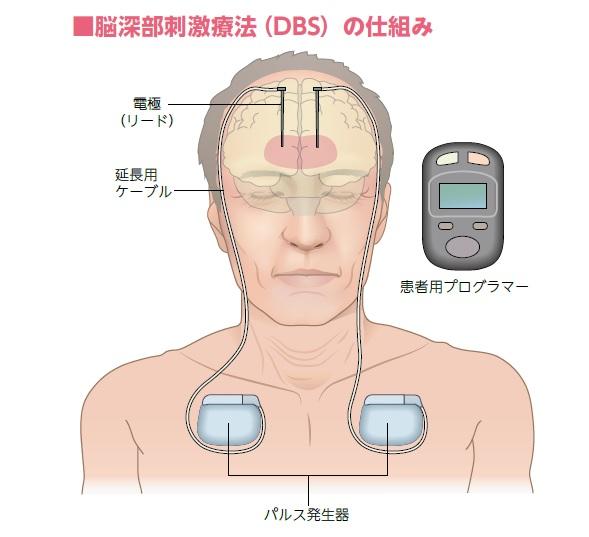 脳の深層部に電極を差し込み、胸部に埋め込んだ装置から電気刺激を送る。運動機能を回復させることを目的とする（イラスト／寺平京子）