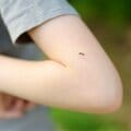 〈夏休みシーズン〉子どもの虫刺され、大人よりはれるのはなぜ? 専門医に聞く、仕組みと対処法
