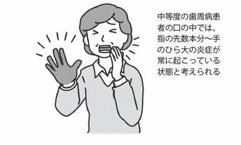 「口は万病のもと」 歯周病による「慢性炎症」が全身に悪影響を及ぼしていた!