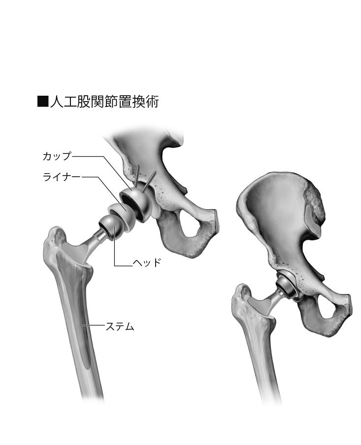 人工股関節置換術。人工関節は、骨盤側のカップ、関節軟骨の役割をするライナー、骨頭にあたるヘッド、大腿骨に埋め込むステムからなる（イラスト／今崎和広）