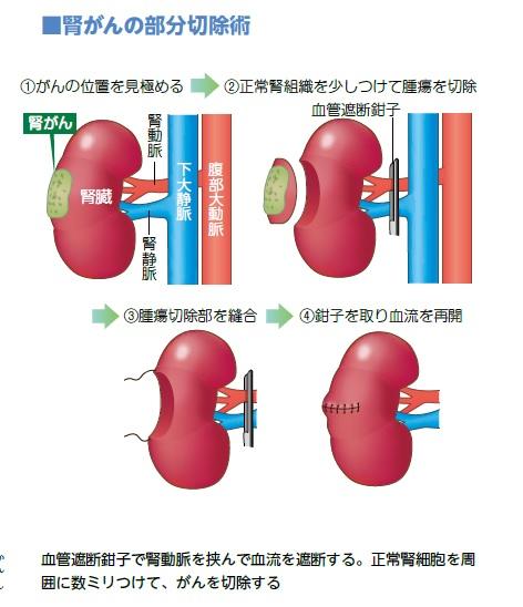 （イラスト／寺平京子）※週刊朝日ムック「手術数でわかるいい病院2019」より　『手術数でわかるいい病院2020』では、腎がんの手術数の多い病院をランキングにして掲載。ランキングの一部は特設サイトで無料公開中。「手術数でわかるいい病院」https://dot.asahi.com/goodhospital/