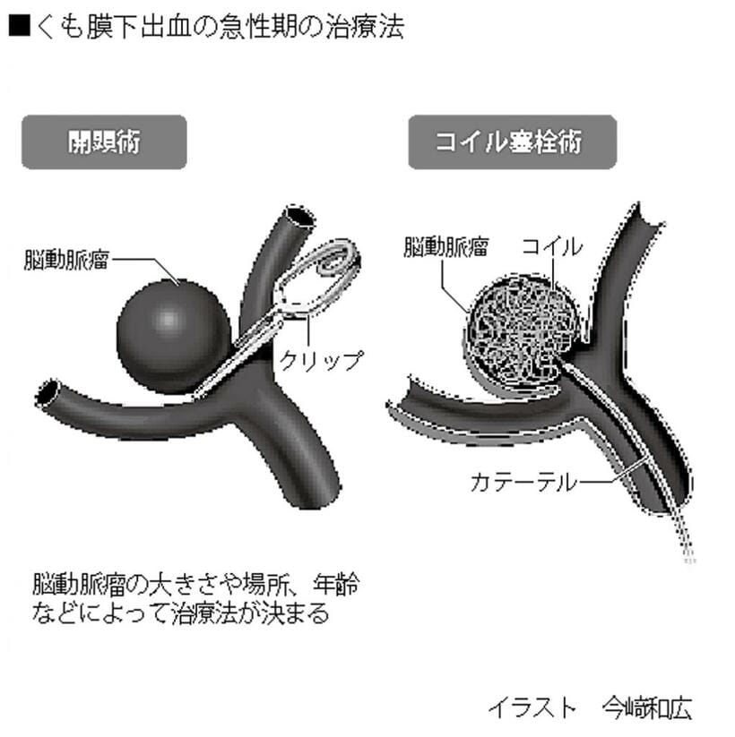 くも膜下出血の急性期の治療法