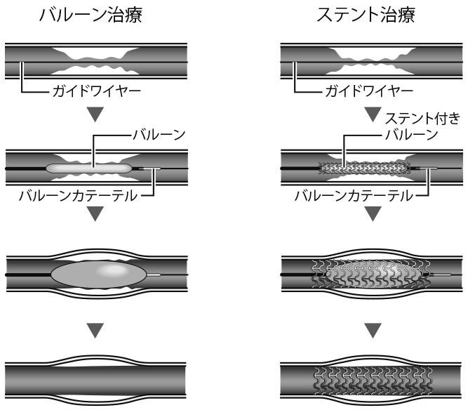 バルーン治療は、薬剤をコーティングしたバルーンを患部で膨らませることにより、狭窄した血管を広げる。ステント治療は、患部に筒状の器具を留置することで、血流を確保する(イラスト/今崎和広)