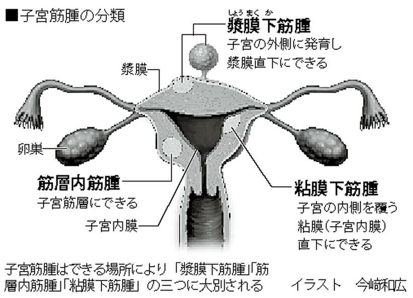 子宮筋腫の分類