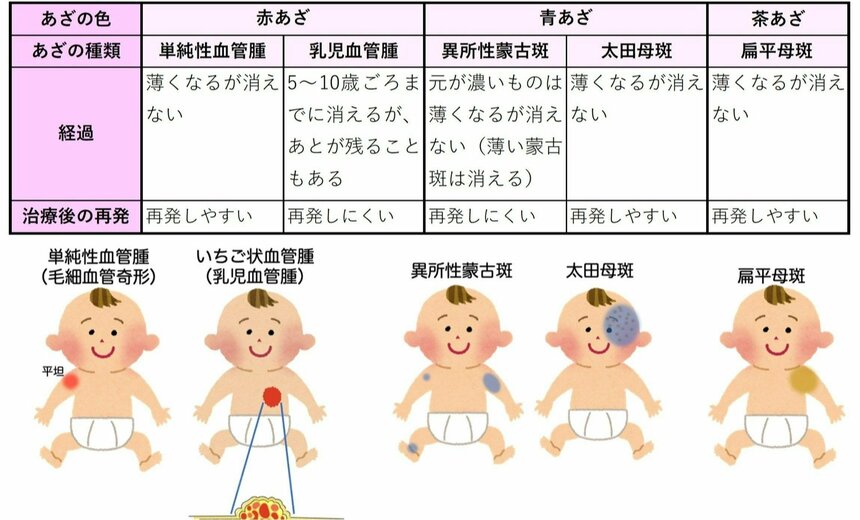 生まれつきの主なあざの種類と経過（図版／日本医科大学武蔵小杉病院提供）