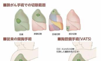 【肺がん手術】専門医に聞くセカンドオピニオンをとるべきケースは?