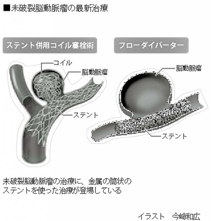 未破裂脳動脈瘤の最新治療