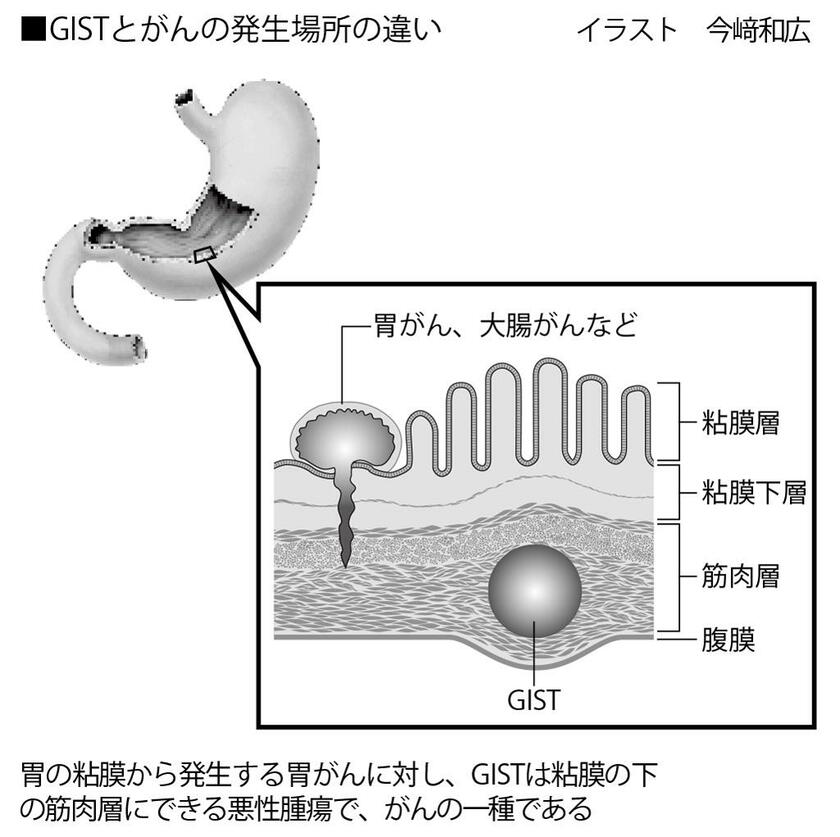 GISTとがんの発生場所の違い