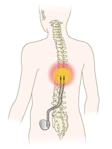 体内に植え込んだ刺激装置から電流が流れ、リード線を伝って脊髄まで届き、痛みを緩和する（イラスト／今崎和広）
