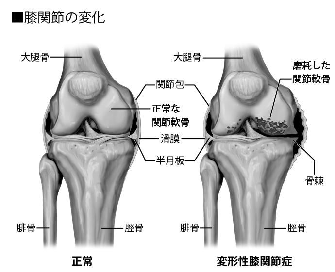 膝関節に負荷がかかると、表面を覆う軟骨が傷つきすり減っていく。滑膜に炎症が起こり、骨が露出してぶつかり合うことで変形が生じる（イラスト／今崎和広）