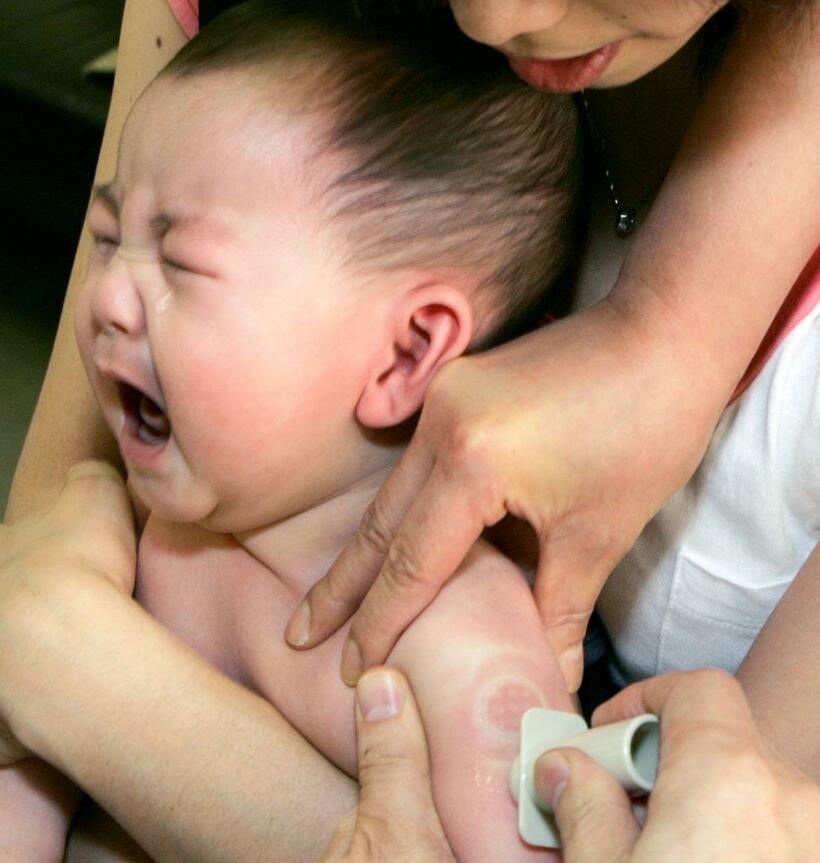 日本では全ての乳幼児が接種対象となっているＢＣＧ。１９４８年に法制化され、９本の針がある「管針」で接種する　（ｃ）朝日新聞社