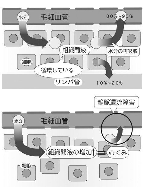 毛細血管には小さな穴が開いている。そこから細胞の間に出てくる水分が、組織間液だ。この組織間液が多くなりすぎたときに「むくみ」が起きる