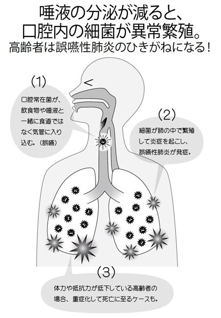 「誤嚥性肺炎には2通りあります。ひとつは物をのみ込む『嚥下力』が弱くなることによって飲食物を誤嚥し、気管に入ってしまうことから起きる誤嚥性肺炎。もうひとつは唾液の分泌が減り、口の中に異常繁殖した細菌が気管に入ることから起きる誤嚥性肺炎。高齢者に多いのは圧倒的に後者です。唾液は口腔内を洗浄し、細菌の繁殖を予防するという役割を担っています。誤嚥性肺炎を防ぐためにも、唾液の分泌は必要なのです」(植田さん)(週刊朝日 2018年6月29日号より)