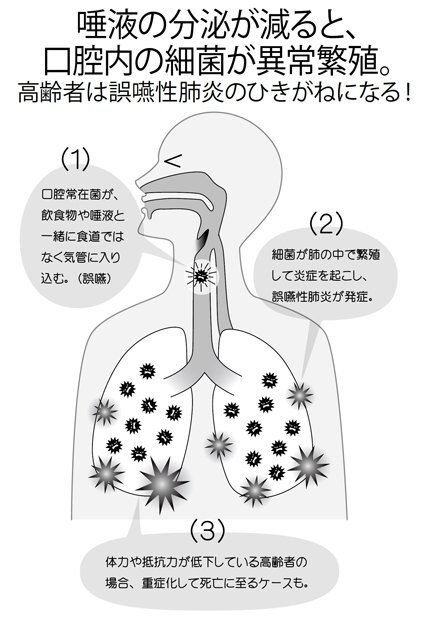 「誤嚥性肺炎には２通りあります。ひとつは物をのみ込む『嚥下力』が弱くなることによって飲食物を誤嚥し、気管に入ってしまうことから起きる誤嚥性肺炎。もうひとつは唾液の分泌が減り、口の中に異常繁殖した細菌が気管に入ることから起きる誤嚥性肺炎。高齢者に多いのは圧倒的に後者です。唾液は口腔内を洗浄し、細菌の繁殖を予防するという役割を担っています。誤嚥性肺炎を防ぐためにも、唾液の分泌は必要なのです」（植田さん）（週刊朝日　２０１８年６月２９日号より）