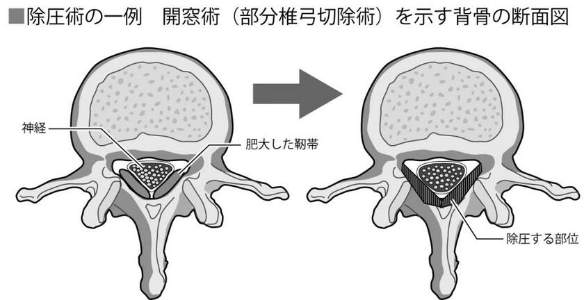 除圧術の一例　開窓術（部分椎弓切除術）を示す背骨の断面図（イラスト・今崎和広）