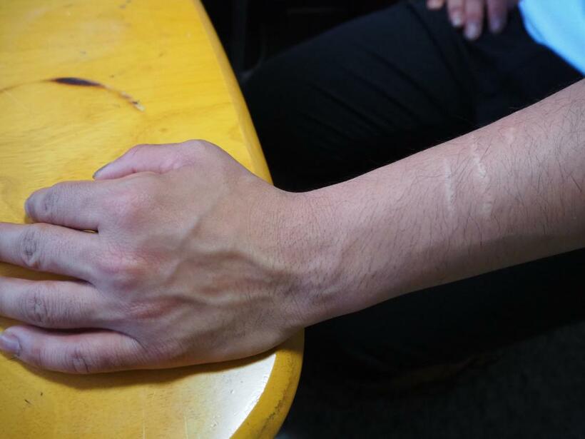 ミョーさんの左腕に刻まれた切り傷の痕（撮影/岩下明日香）