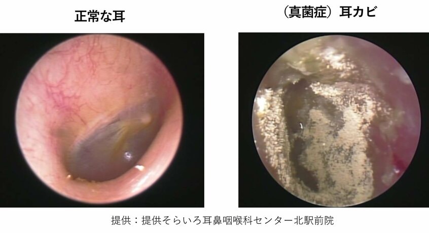 右の画像が、外耳道真菌症になった状態の耳の中。白い部分が「カビ」だという。