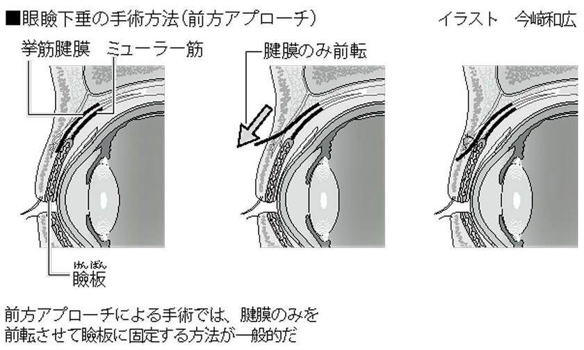 眼瞼下垂の手術方法