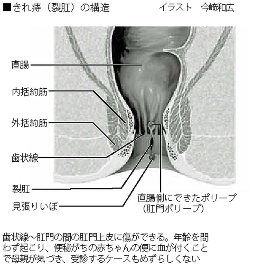 きれ痔(裂肛)の構造