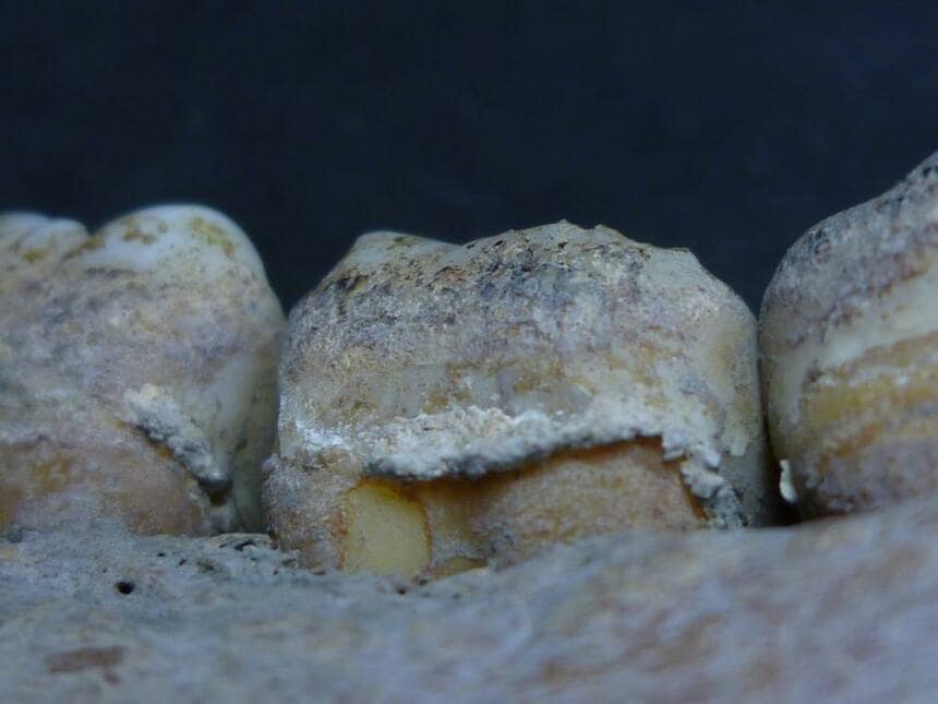 発掘された人骨の歯にこびりついた歯石（写真／澤藤りかい）