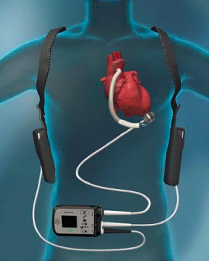 体内型の補助人工心臓の装着イメージ　（小野教授提供）