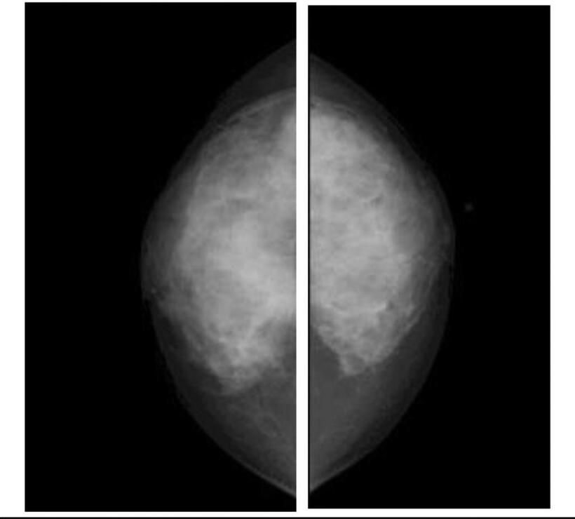 Ｘ線マンモグラフィーで撮影した乳がん患者の乳房。乳房全体が白く映る「高濃度乳房」の特徴がみられ、がん組織と正常組織の判別が難しい（写真：木村建次郎研究室提供）