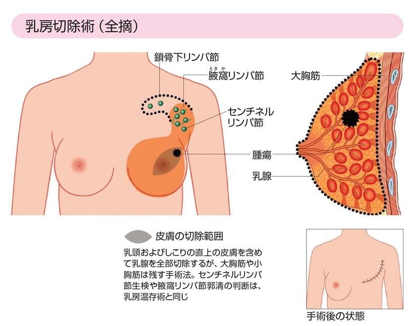 「乳房切除（全摘）」では、がんのある側の乳房全部を切除する（イラスト／河島正進）