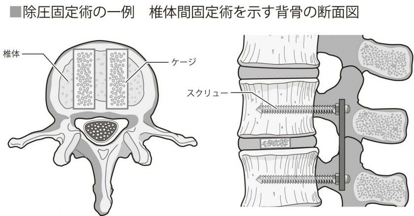 固定術の一例　椎体間固定術を示す背骨の断面図（イラスト／今崎和広）