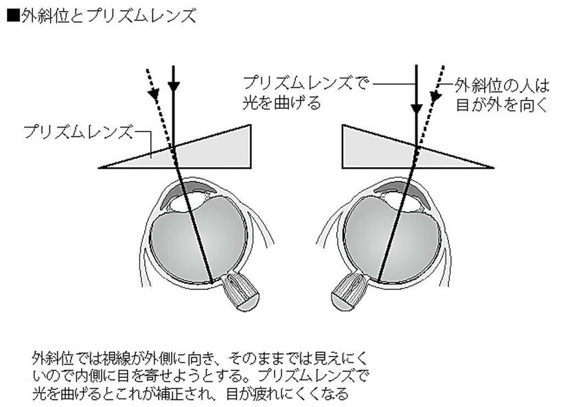 外斜位とプリズムレンズ