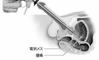 多発・再発しやすい膀胱がん 取り残しや再発を防ぐための治療法とは