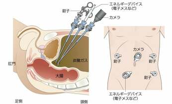 【大腸がん手術】専門医に聞くセカンドオピニオンをとるべきケースは?