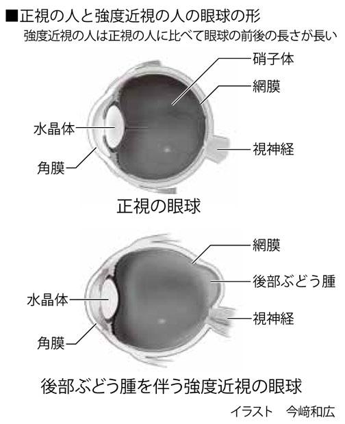 正視の人と強度近視の人の眼球の形　（週刊朝日２０１９年７月１２日号より）