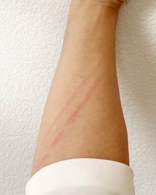 発症の7割は子ども「猫ひっかき病」ってどんな病気？　発熱や全身倦怠感が1カ月以上続くことも【専門家に聞く】