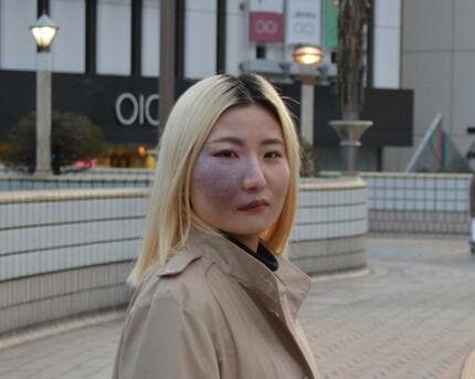 SNSで顔にアザの写真を公開し取材殺到も…「単純性血管腫」の26歳女性が抱えた葛藤 | AERA dot. (アエラドット)