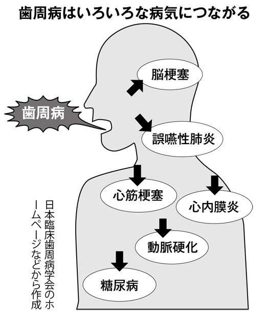 歯周病はいろいろな病気につながる（週刊朝日２０１８年９月２８日号から）